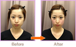 驚きの美小顔「小顔美顔矯正法」01