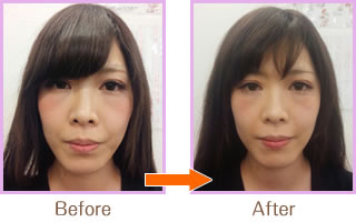 驚きの美小顔「小顔美顔矯正法」03