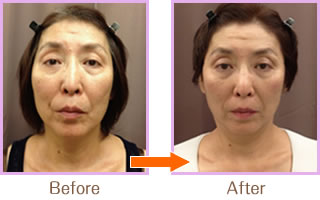 自然なエイジングケア美肌を「シワ取り美顔矯正法」01