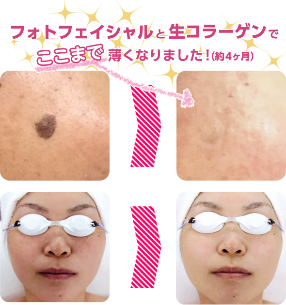 フォトフェイシャルについて02