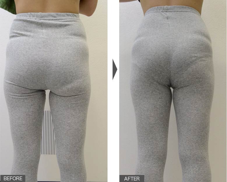 骨盤が正常になり、たるみ・腰痛・ひざ痛が改善！01