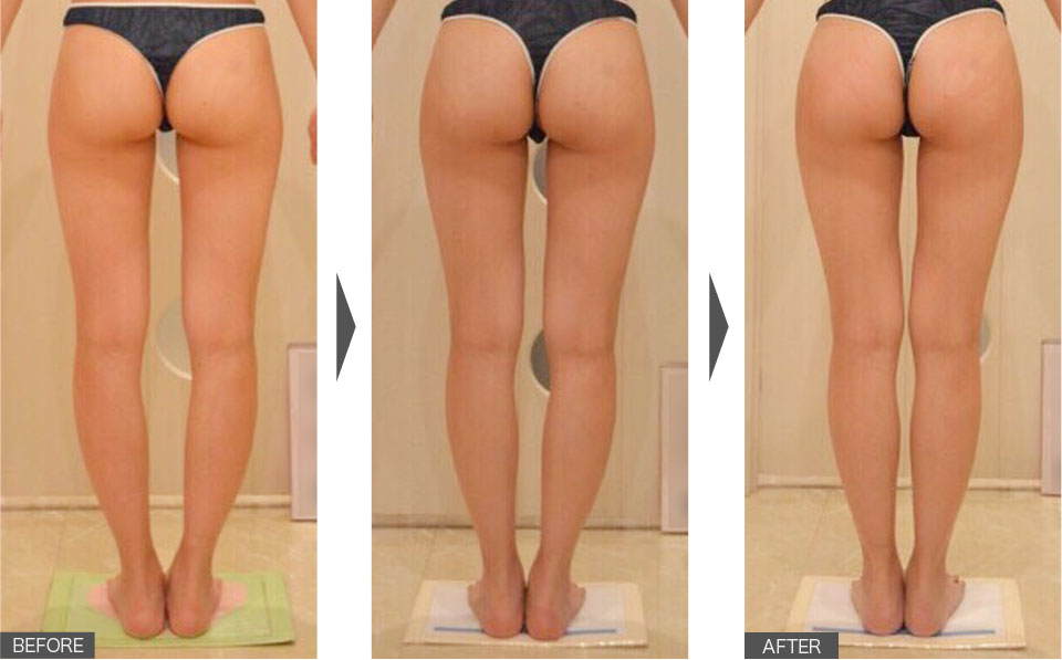 1ヶ月で骨盤が正常になり、食べても太りにくいスラっと脚に！03