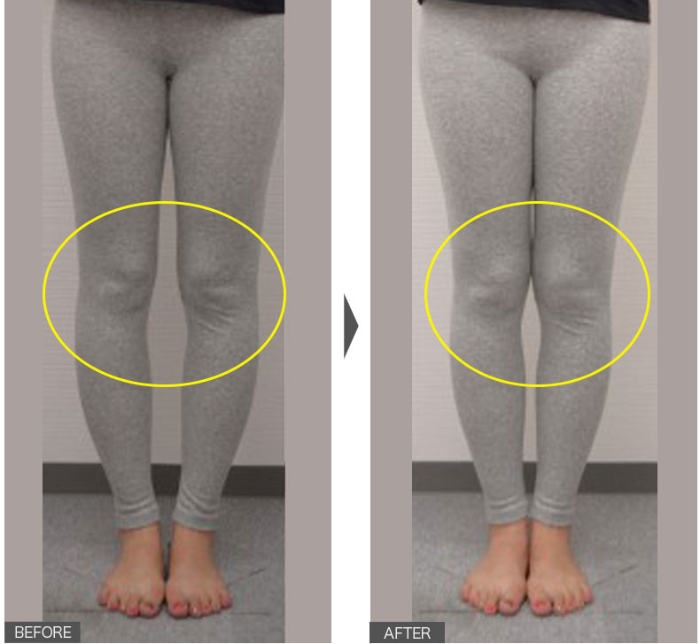 癖によってどんどん歪んでいたＯ脚も、たったの1回でこの通り！女性／1回