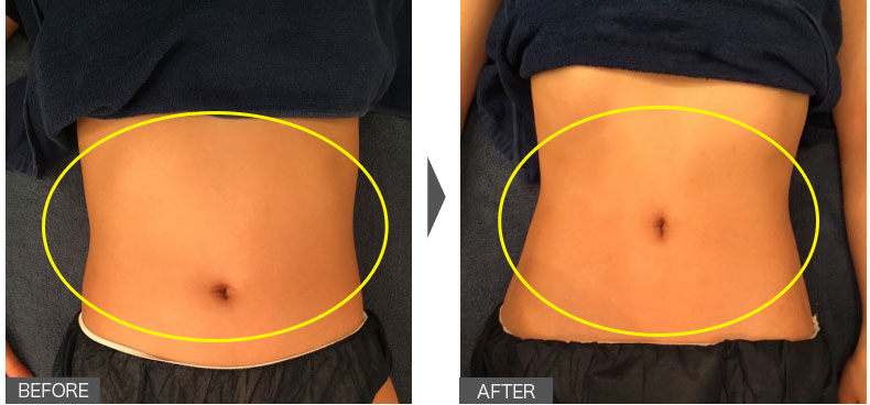 ぽっこりお腹とおさらば！女性／1ヶ月