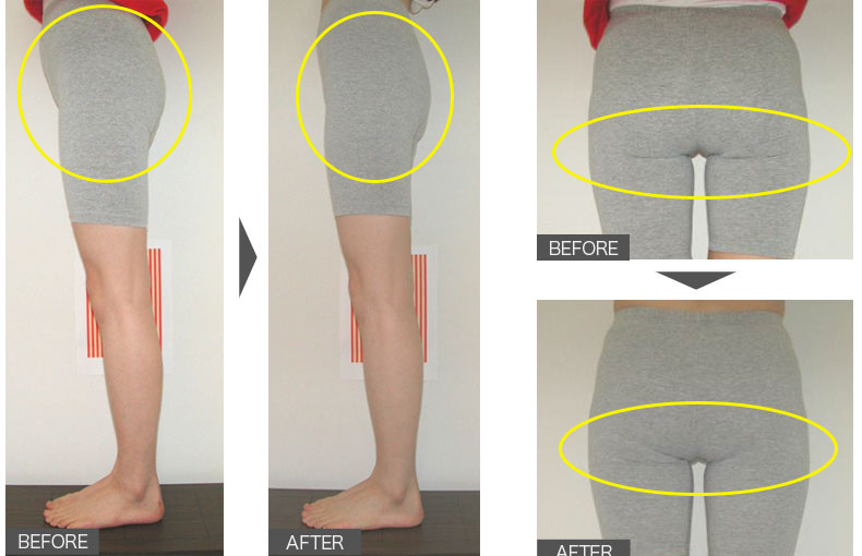29歳女性／2ヶ月／下半身痩せ