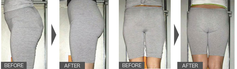 女性／左右非対称の変化、下腹部の減少、脊椎の前湾の減少、生理痛の減少