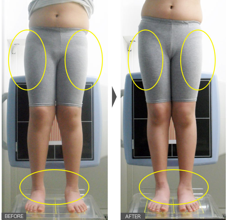 12歳女性／22週間／X脚矯正、太もも痩せ