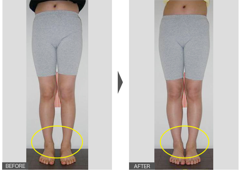 12歳女性／6週間／X脚矯正